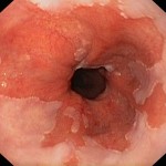 Barrett's oesophagus