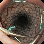 Metal oesophageal stent