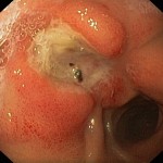 Duodenal ulcer