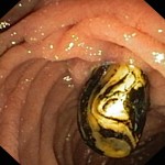 Impacted gallstone