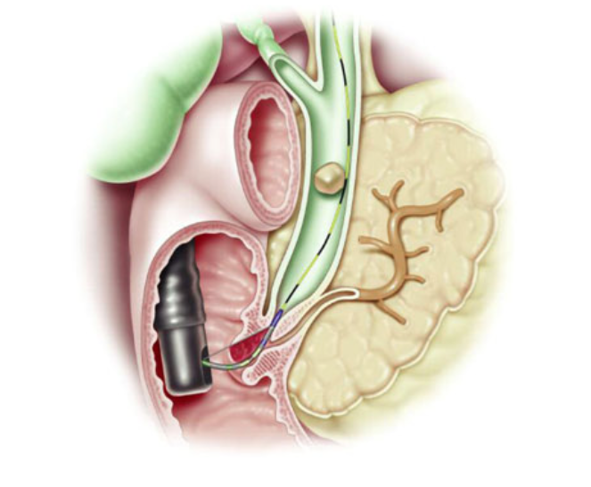 Stone within common bile duct - courtesy ASGE.org